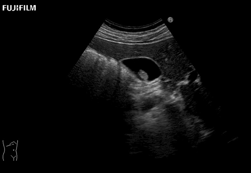 Gall Bladder NonShadowing Stone