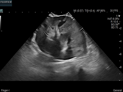 Liver Surgery Procedure using C22I