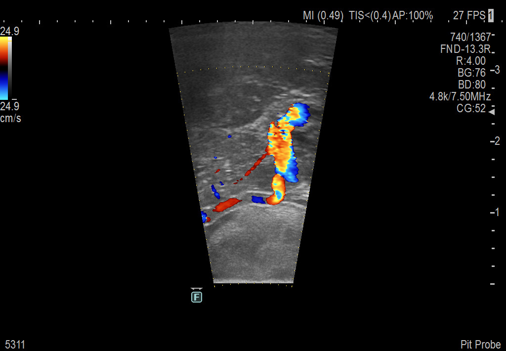 Pituitary Procedure using UST-5311