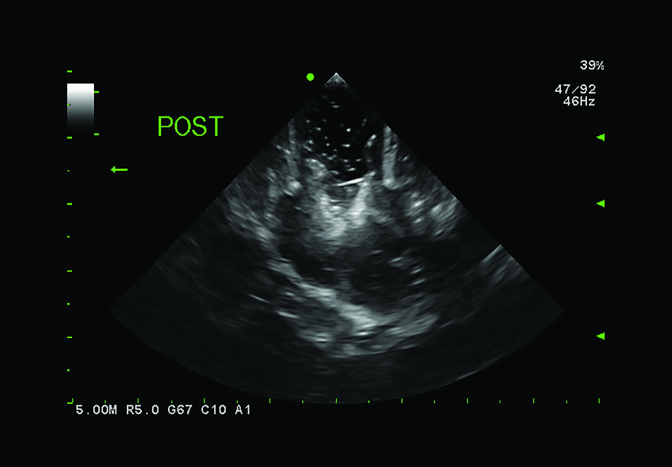 Subcortical Procedure using S12BP4