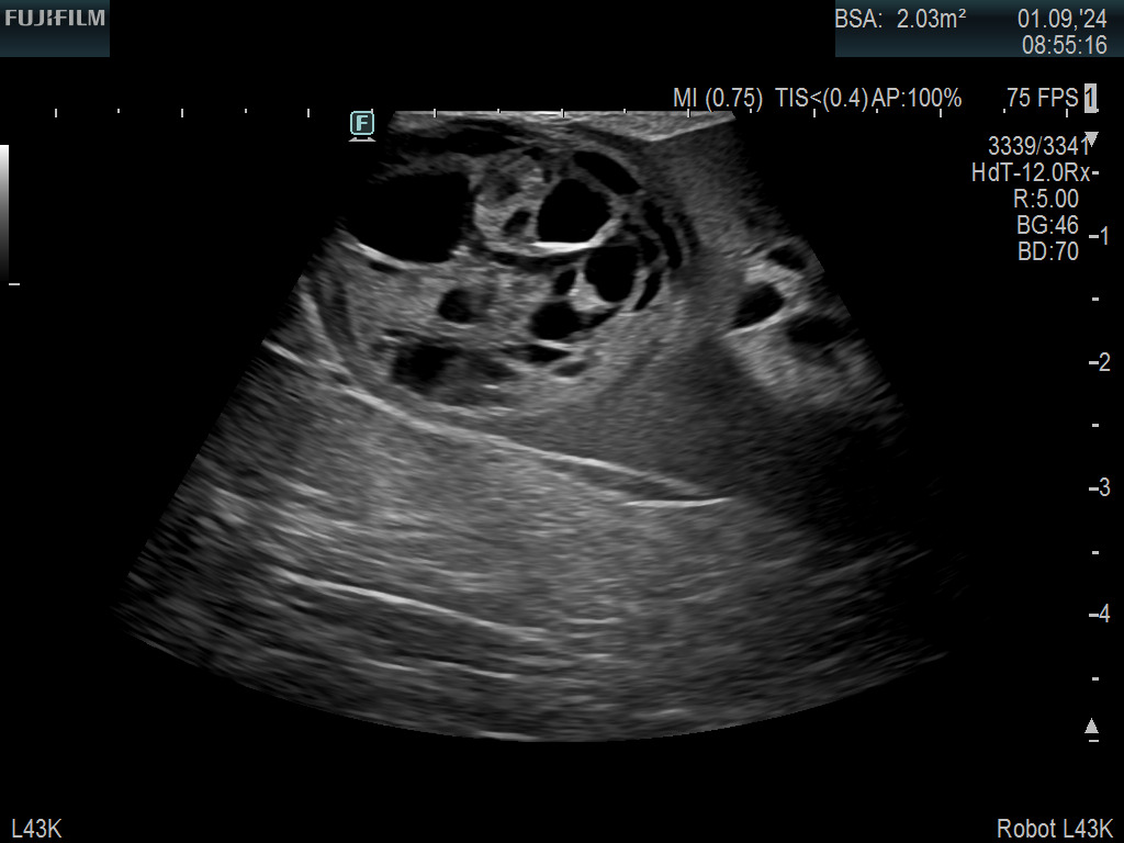 Robotic Surgery on Kidney with Complex Mass using the L43K Drop-In