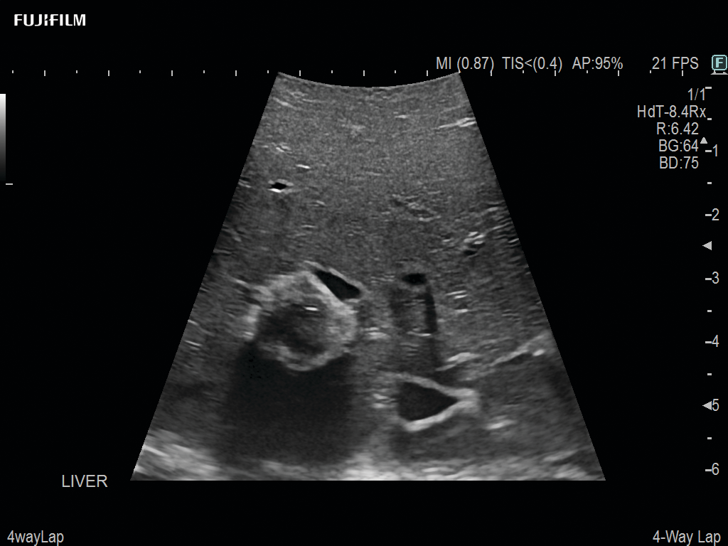 Laparoscopic Partial Nephrectomy& Hepatectomy using C9150LA