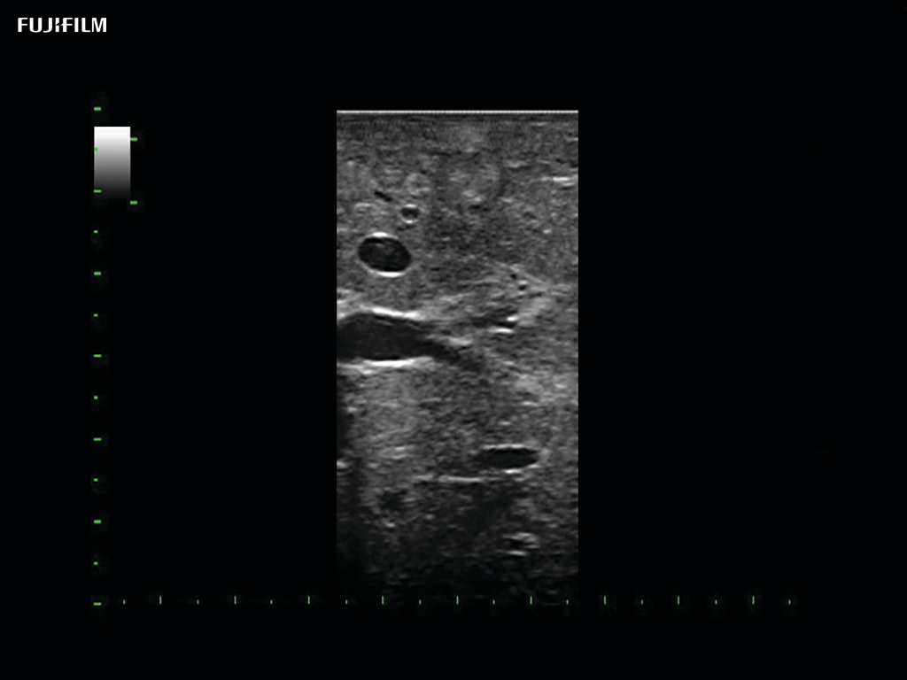 Liver Metastasis using L46K1