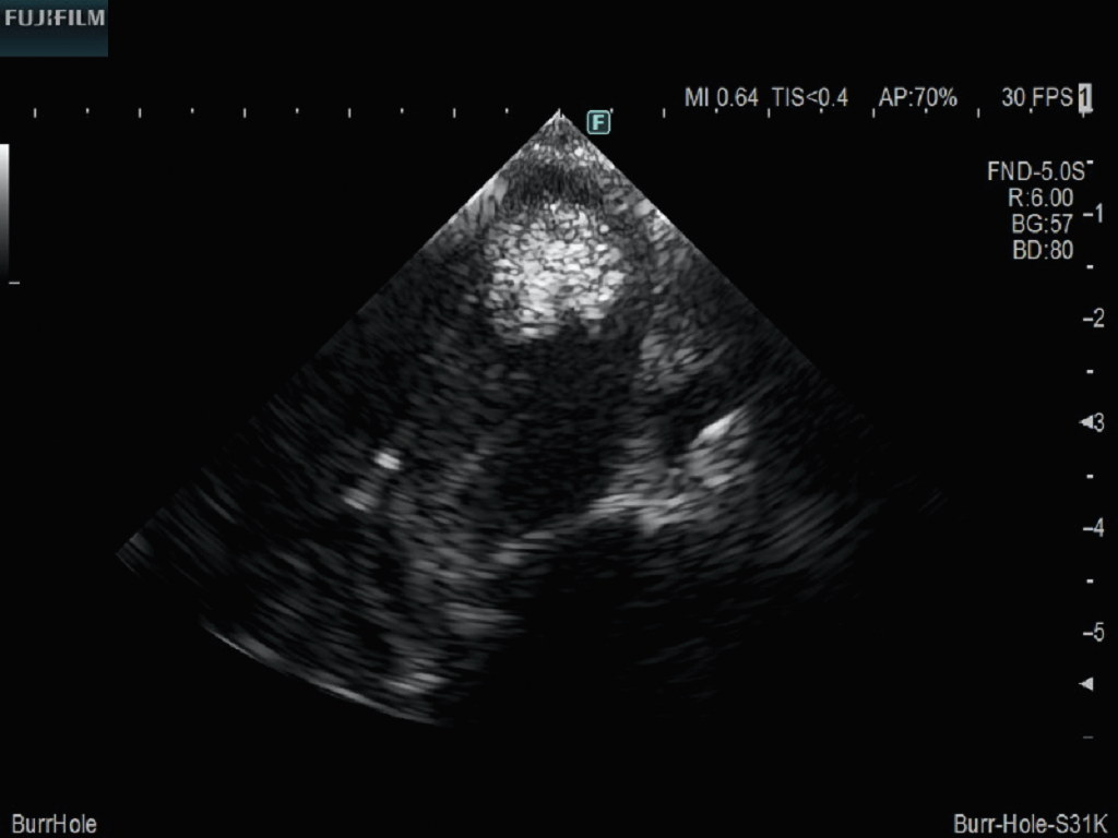 Burr Hole Procedure using S31KP