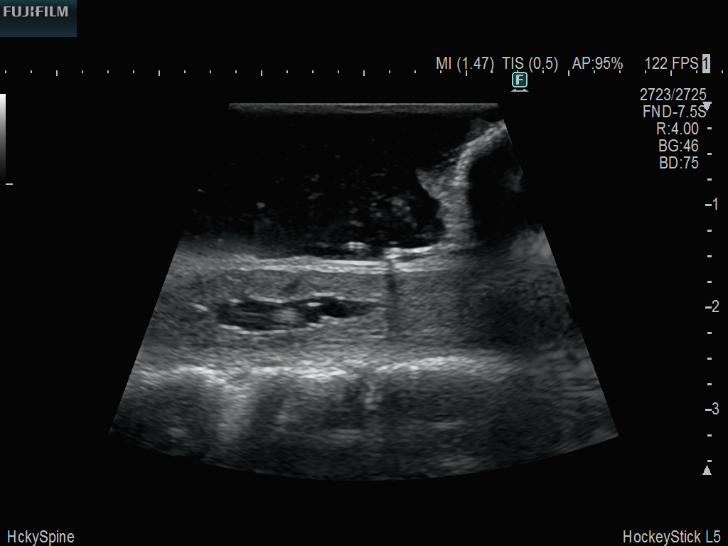 Spinal Procedure using L53K